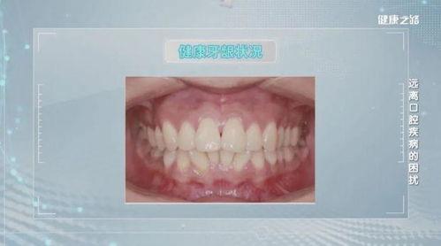 牙龈烂了图片,揭秘口腔健康危机与防治之道